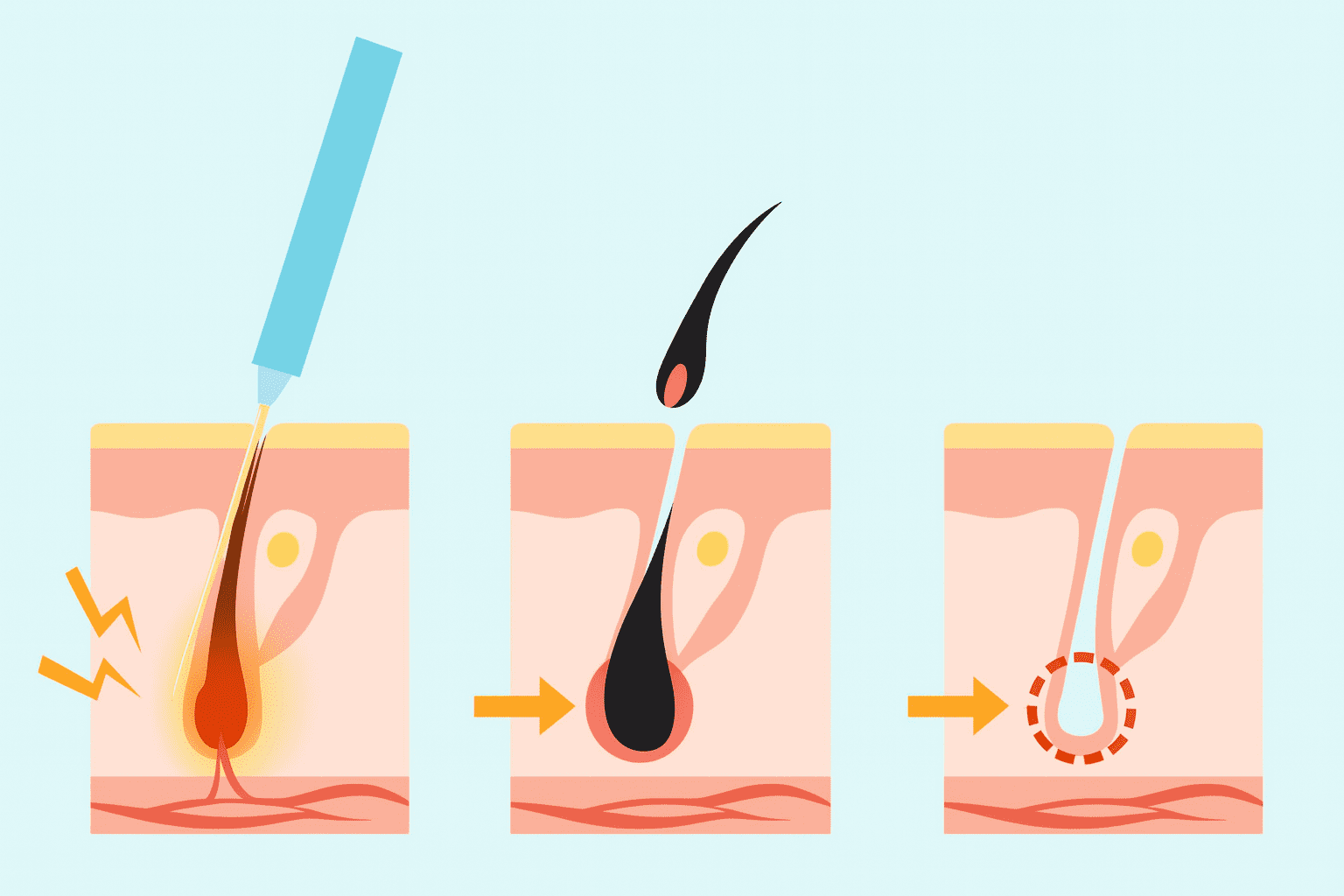 Electrolysis probe and hair follicle diagram